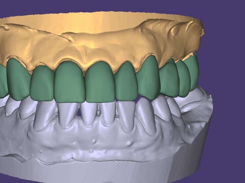 3D design: Full Upper Arch: Crowns + Bridge