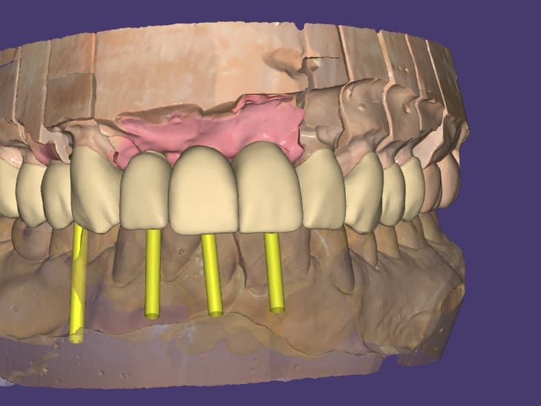 3D design: Full-Arch Bridge on 4 Implants