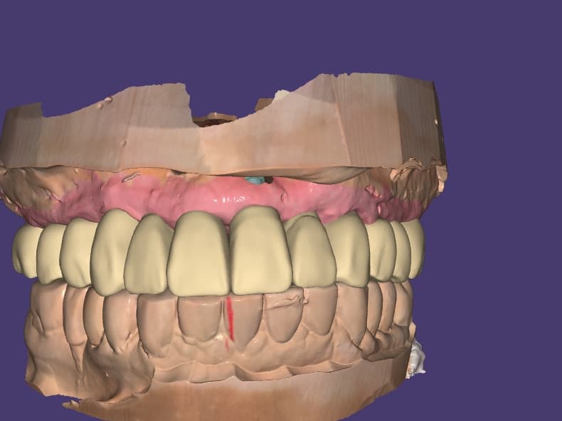 3D design: Full-Arch Upper on 10 Implants