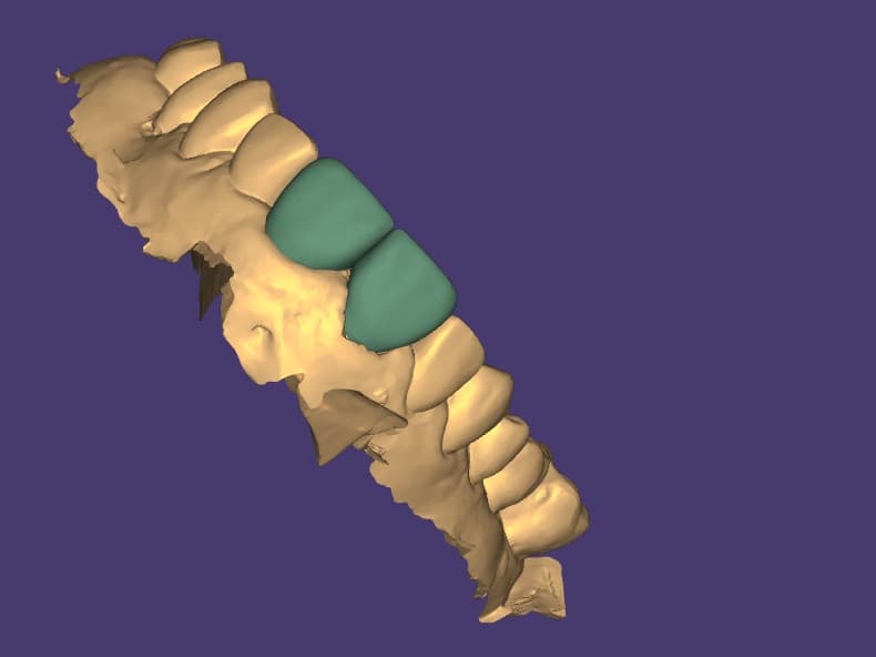 3D design: Custom Implant Abutment