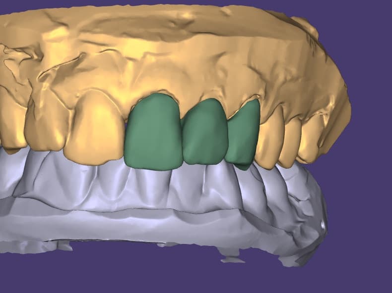 3D design: Upper Anterior Restorations